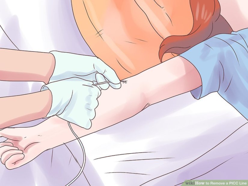 Remove-a-PICC-Line-Step-9
